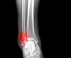 Bệnh Gãy xương chày: Nguyên nhân, biến chứng và cách điều trị
